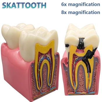8-кратная модель кариеса зубов, модель зубов для демонстрации зубов, модель обучения стоматолога, Зуботехническая лаборатория, исследование полости рта